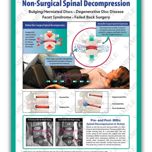 Non-Surgical Spinal Decompression (NSSD) Poster