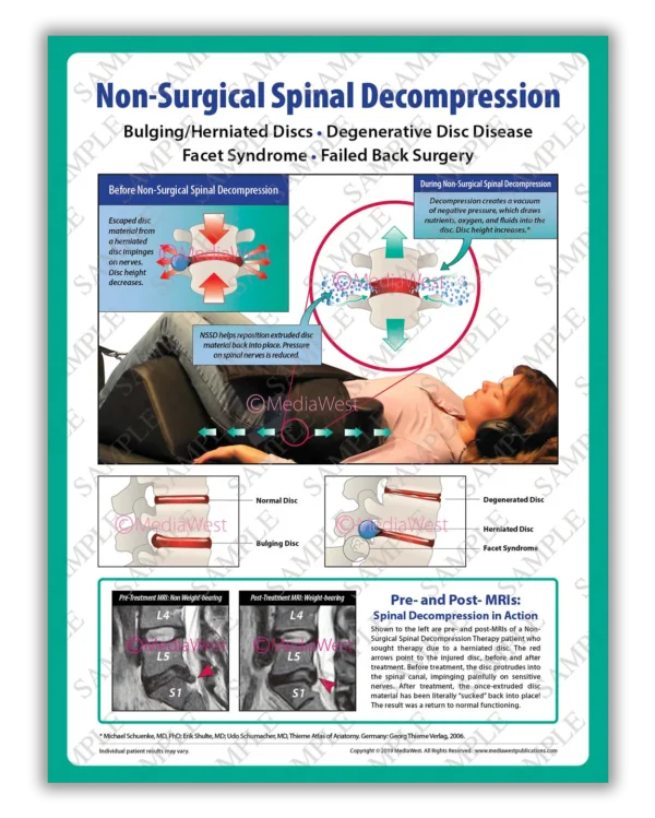 image-posters-v3-nssd Non-Surgical Spinal Decompression (NSSD) Poster